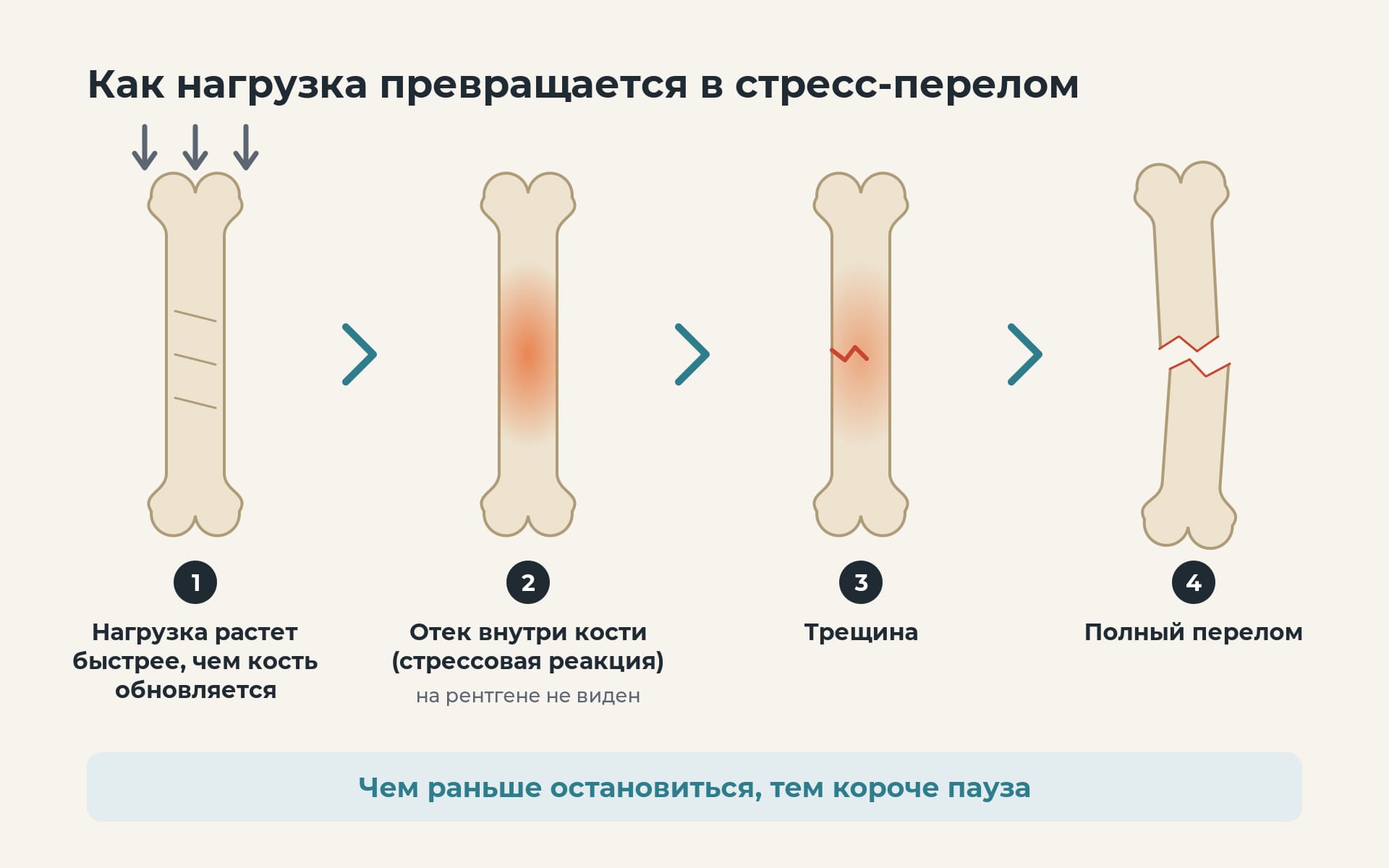Как нагрузка превращается в стресс-перелом: от отека кости до трещины