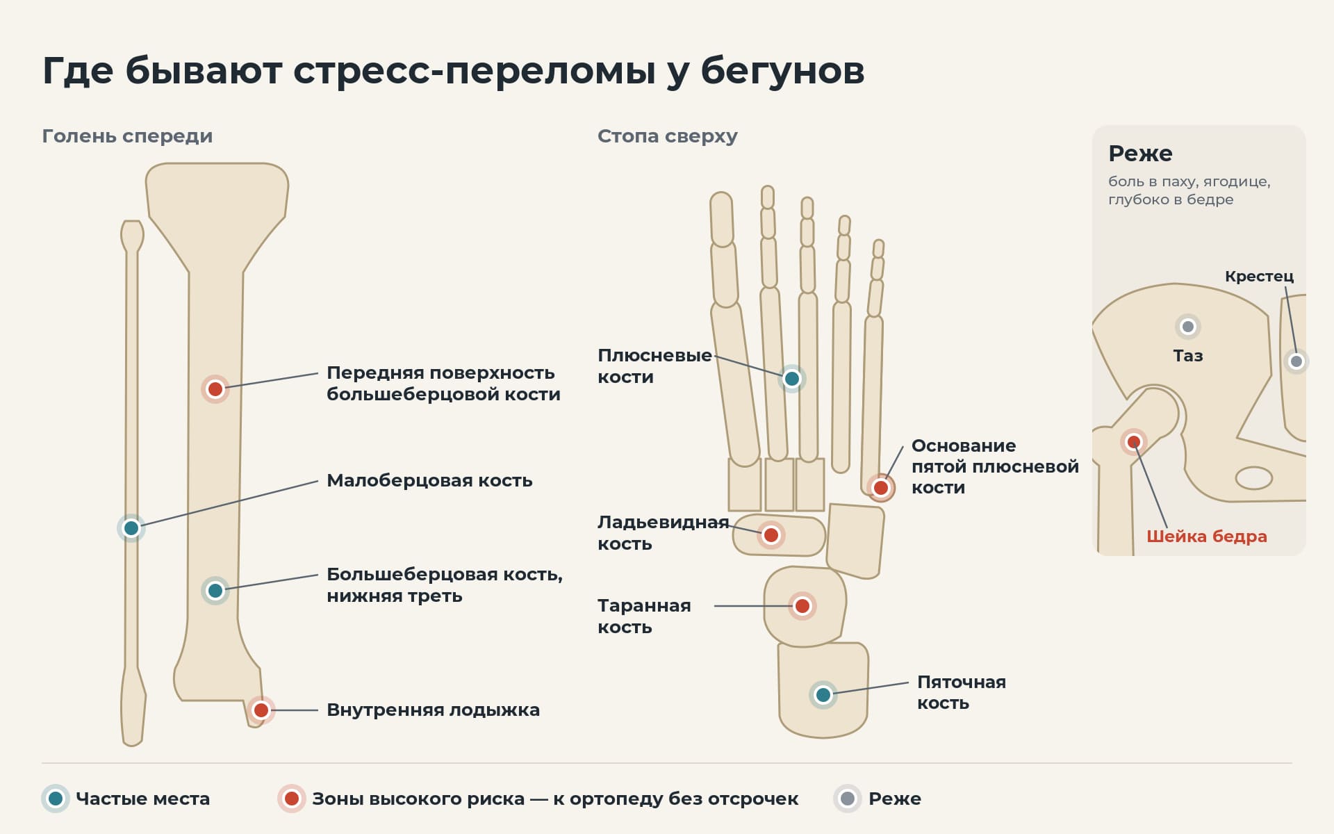 Схема стопы и голени с частыми местами стресс-переломов